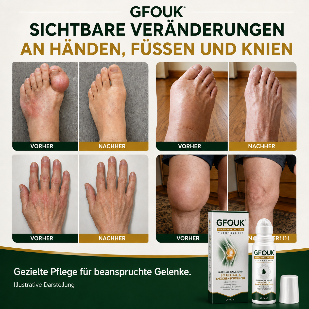 GFOUK® 0,05 mm Mikro-Nadel-Roller zur Unterstützung der Knochen- und Gelenkregeneration